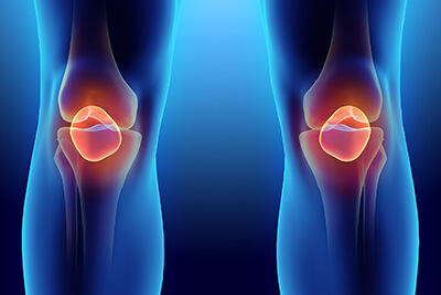 Torn Meniscus Stem Cell Treatment in San Antonio, TX